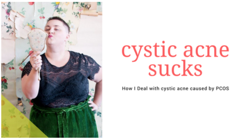 tips for Cystic Acne caused by PCOS